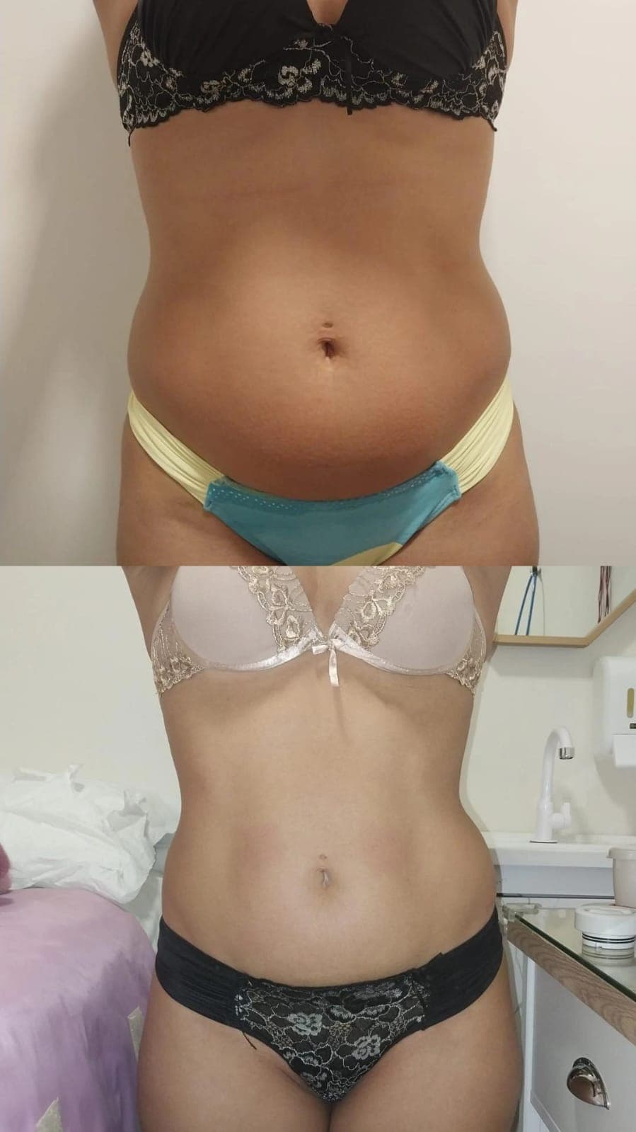 Ativação circulatória em áreas críticas de celulite