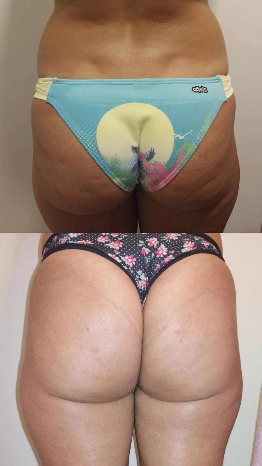 Massagem modeladora em coxa - tratamento anticelulite